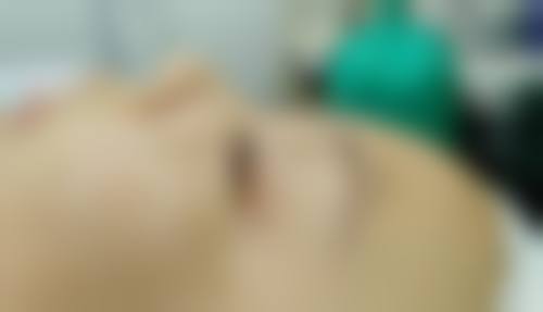 常年打瘦脸针会怎样