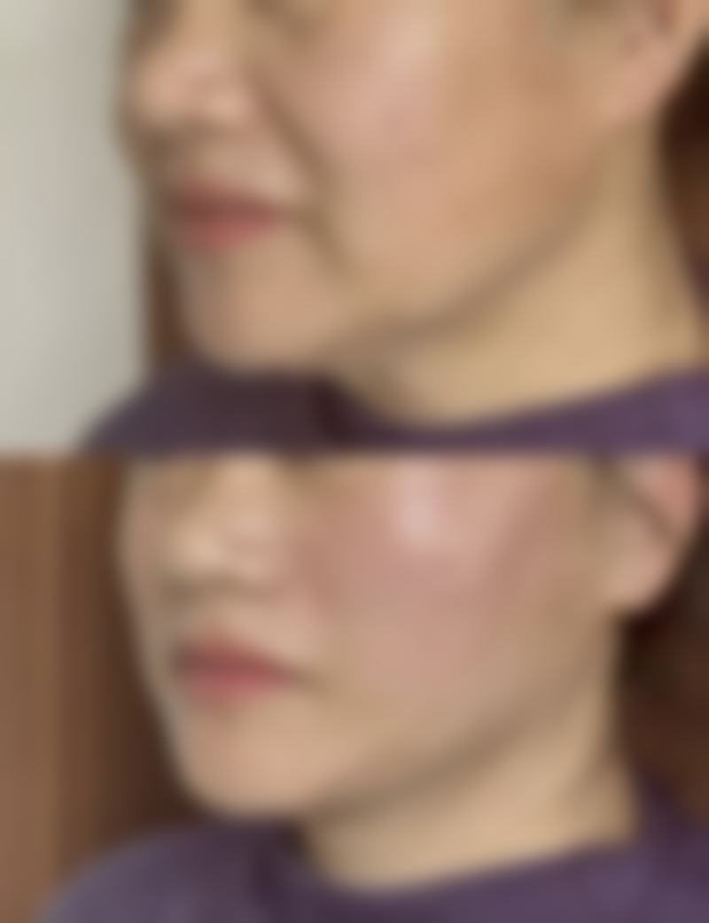 做完光子嫩肤后多久可以打水光