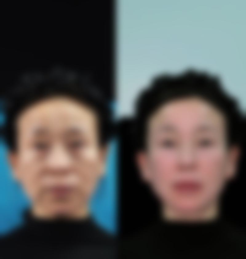 评价一:“我在襄阳佳萱医疗美容门诊部做了除皱抗衰项目,成效真的太棒了!医生的技术特别娴熟,整个过程没有什么疼痛感,而且服务人员也特别贴心,术后还会定期回访,关心我的修复情况。现在我的皮肤变得紧致有弹性,感觉年轻了好几岁呢。”