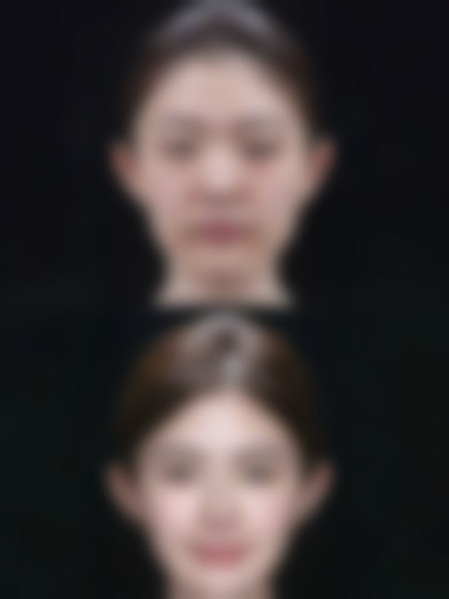 做完光子嫩肤后注意事项