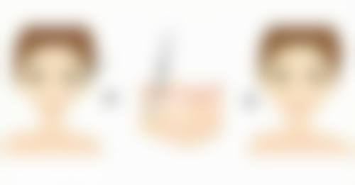 打完瘦脸针嘴有点歪是怎么回事