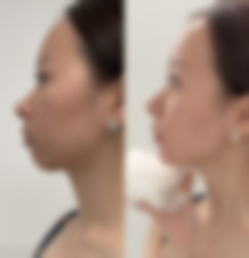 如何促进瘦脸针成效的呈现