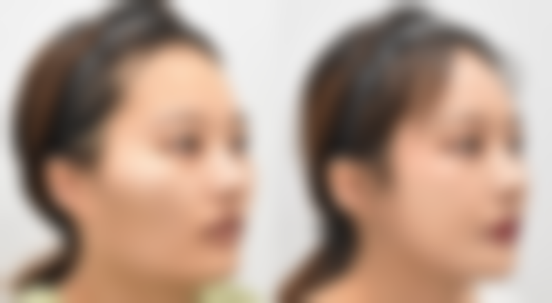 阴道紧缩手术成效怎么样