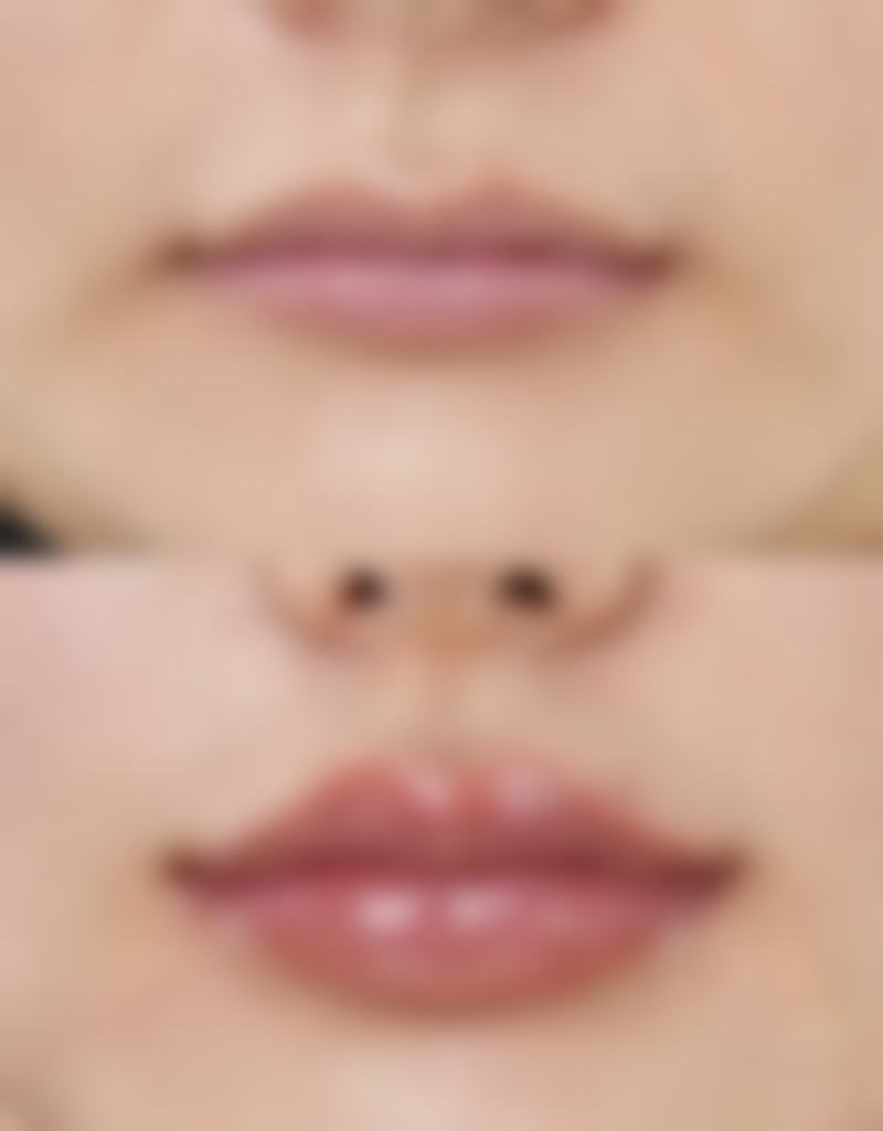 打了瘦脸针嘴角变歪了怎么办