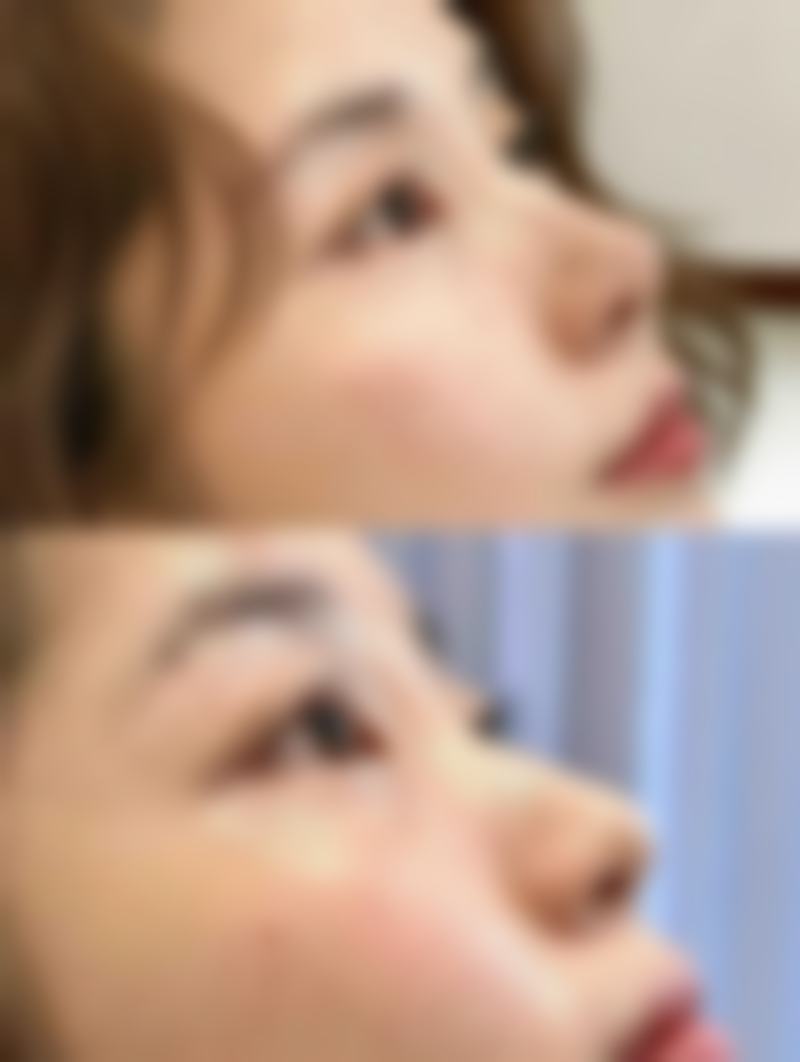 面部除皱针能保持多久