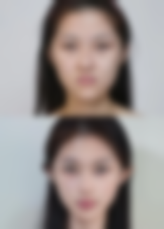 白毒瘦脸针能维持多久