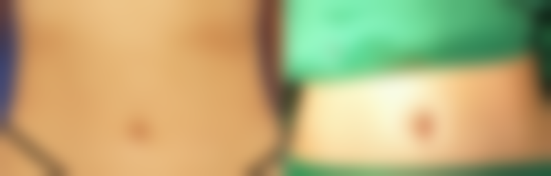 除皱针打一次维持多久？揭秘3 - 6个月效果背后的真相，让你轻松拥有年轻肌肤！ 