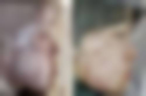 注射瘦脸针的价格