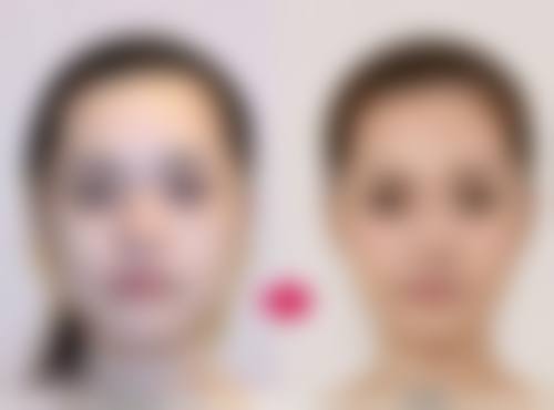 打完瘦脸针正确的睡姿