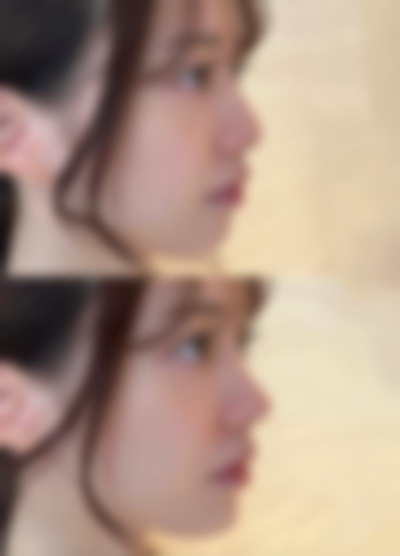 打瘦脸针有什么副作用？有依赖性吗？