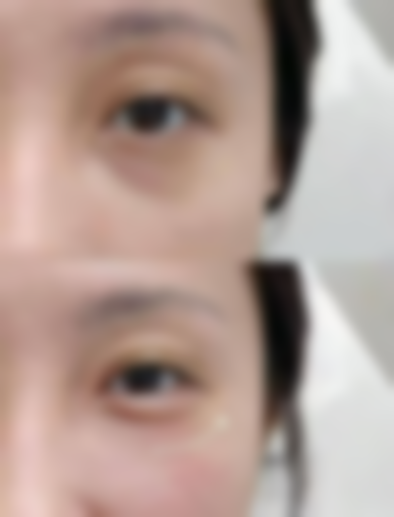 毛发种植的术前准备和术后注意事项