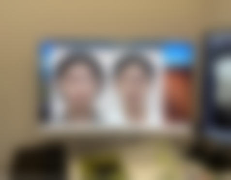 打完瘦脸针脸颊凹陷能修复到以前的样子吗？