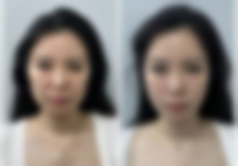 注射瘦脸针的优点