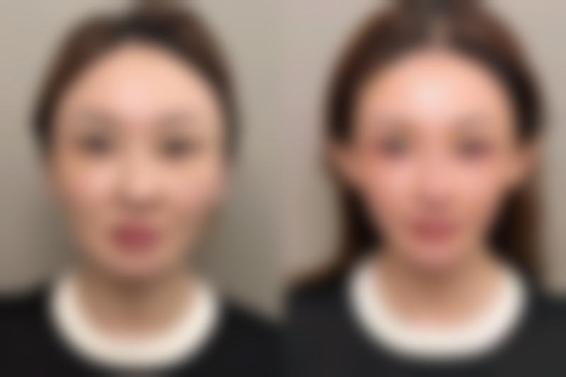 注射美白针有危害吗？权威解析美白针成分与作用机制，揭秘其安全性与潜在风险！ 