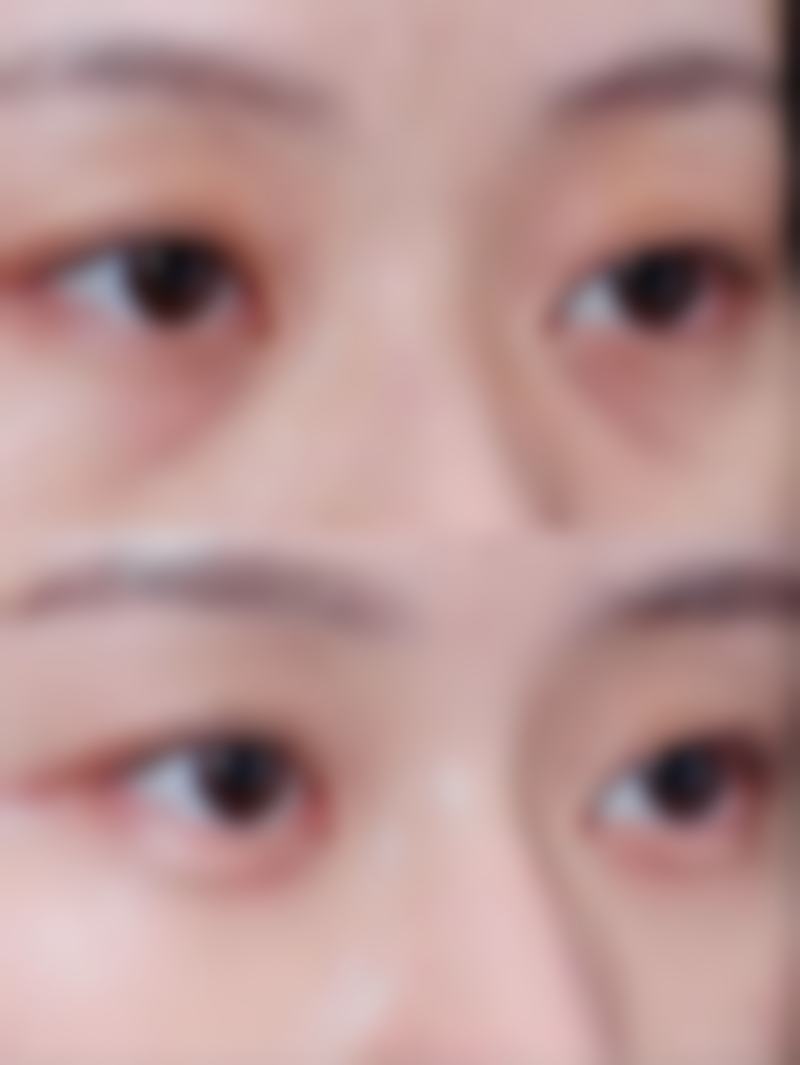 注射除皱可以维持多久