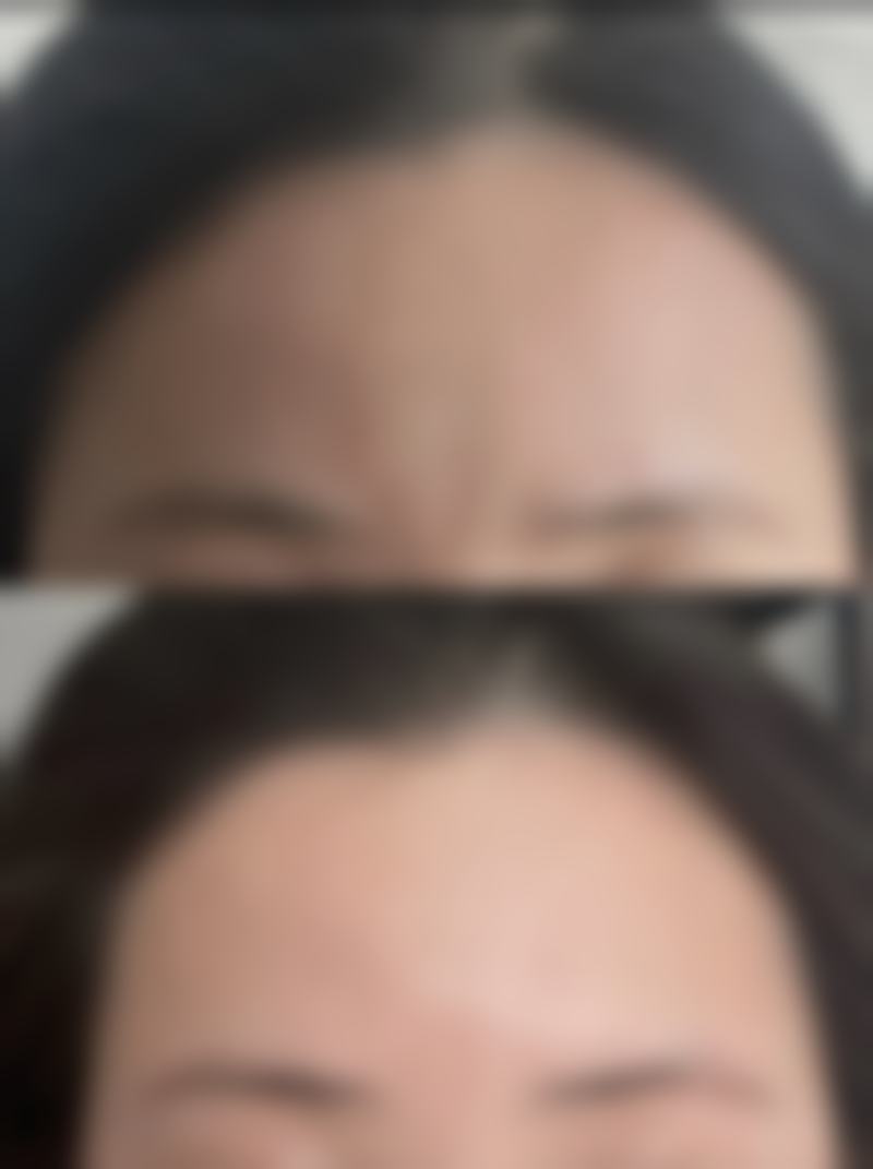 面部除皱针能保持多久