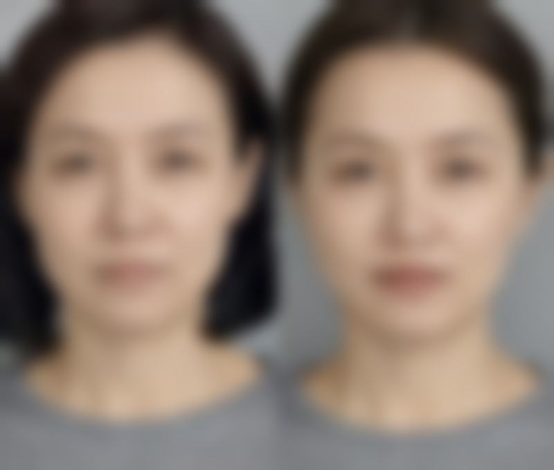 注射美白针有危害吗女性