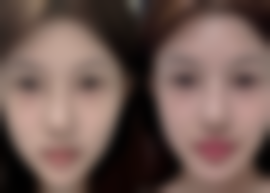 注射除皱针多久可以洗脸