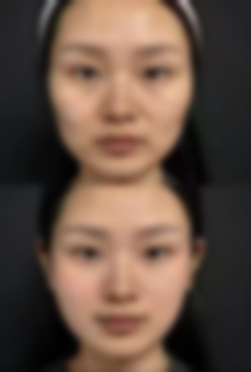 注射美白针有副作用吗