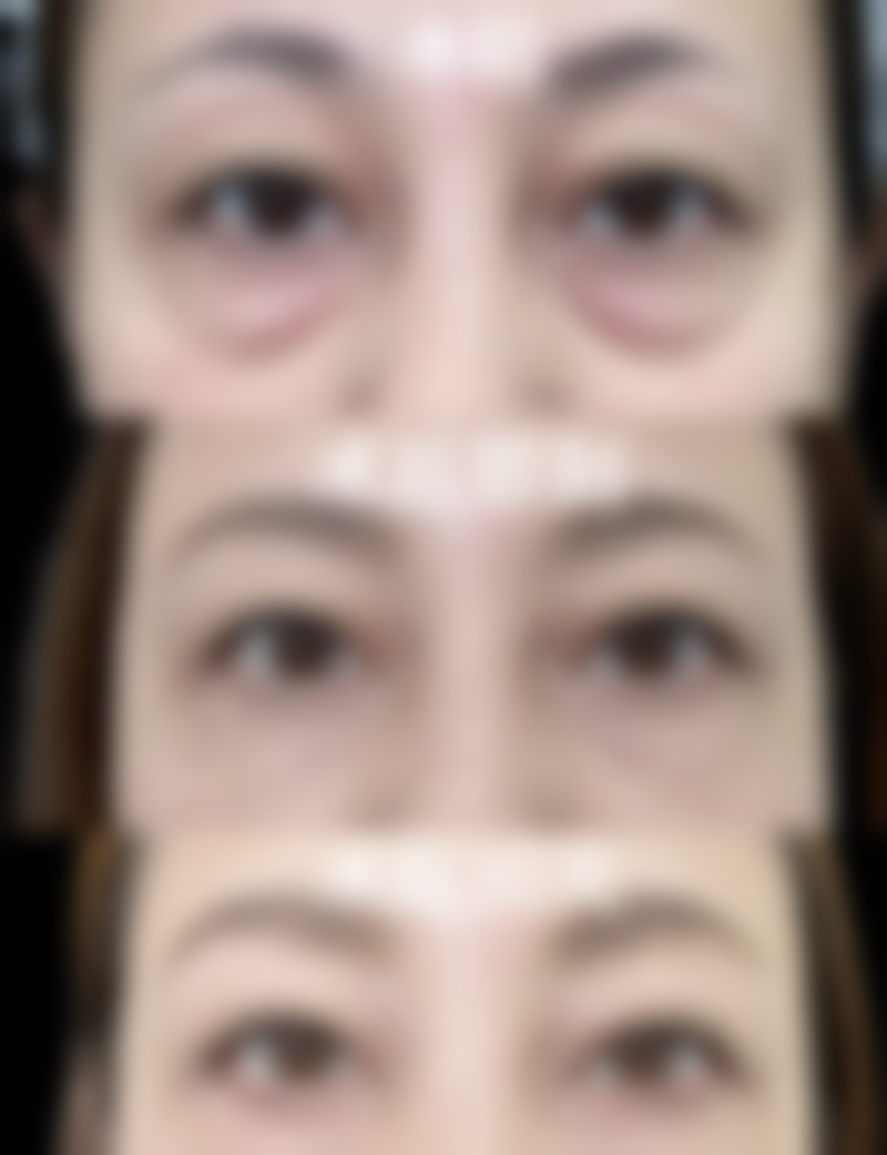 注射美白针美白成效