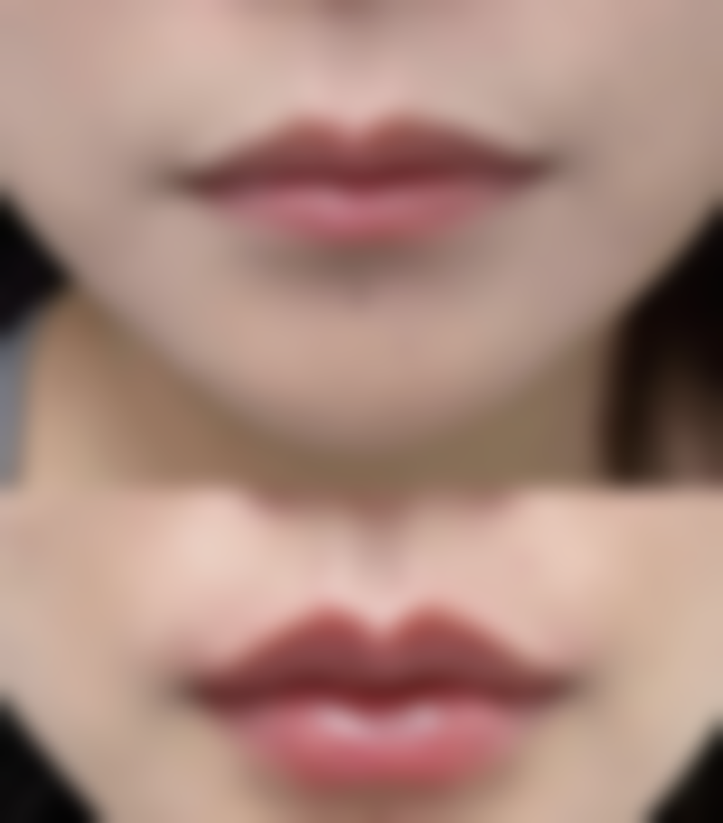 注射美白针有成效么