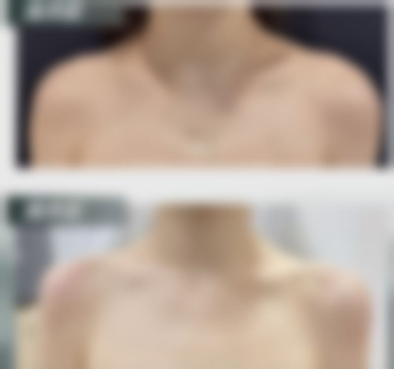 瘦脸针的治疗过程