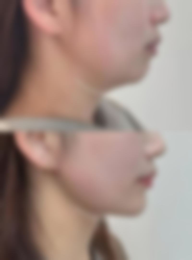 扎瘦脸针多久能见效