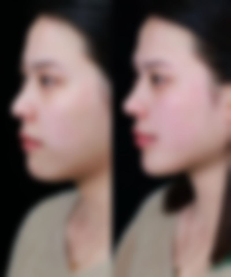 扎完瘦脸针多久有效果？揭秘3-7天初步显效、1-2个月最佳效果的神奇瘦脸时间线！ 