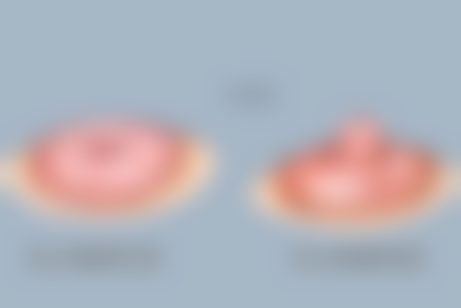 拉皮手术属于微整吗