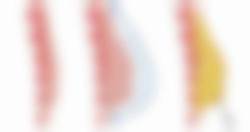 拉皮手术算整容吗