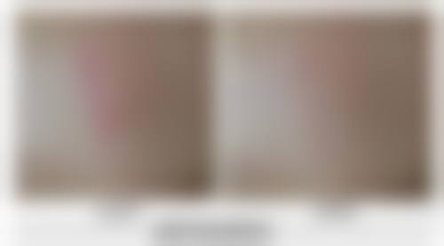 拉皮手术有风险