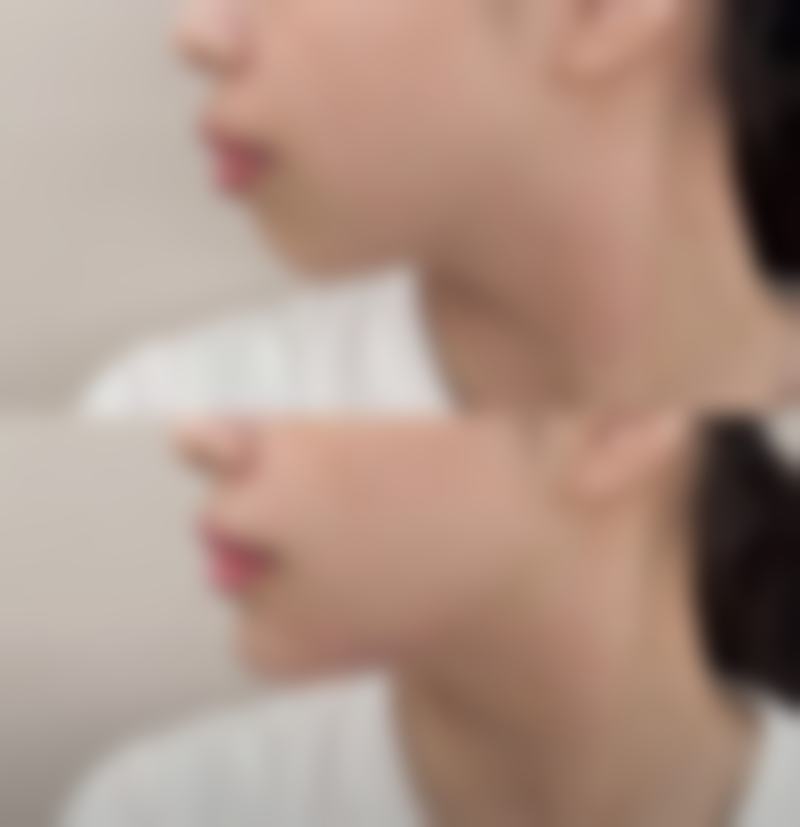 拉皮手术遭罪吗