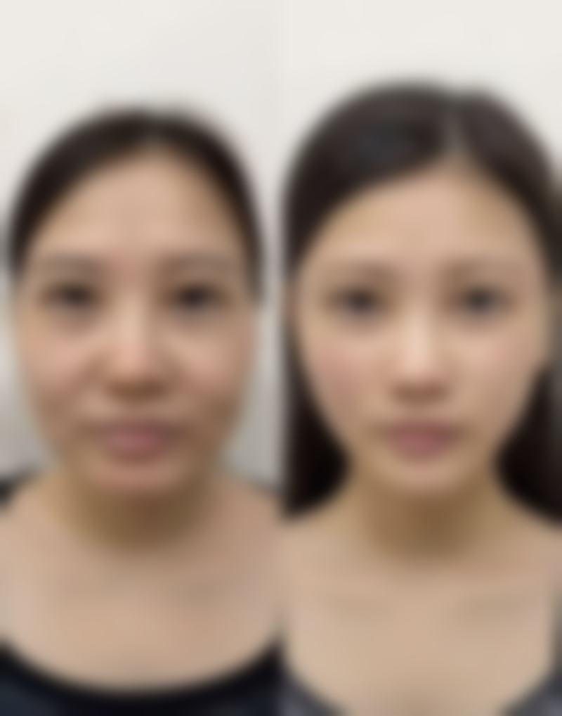 瘦脸针韩国白毒好吗