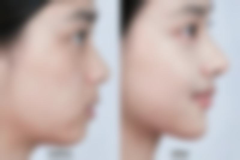 瘦脸针多久打一次成效至佳