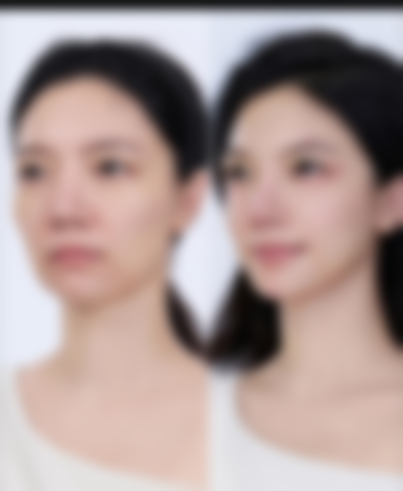 瘦脸针能维持多久