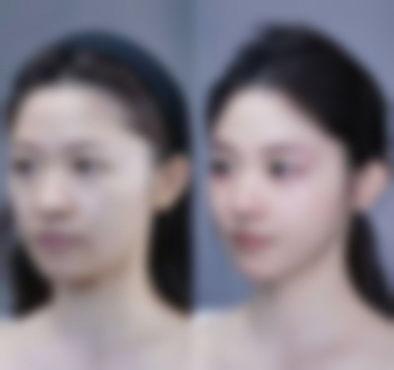 瘦脸针多久开始见成效