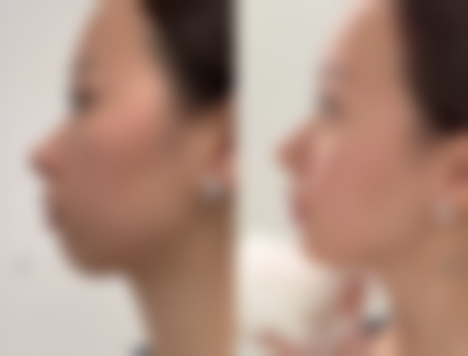 女生天生头发稀少可以植发吗