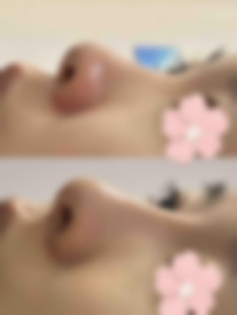 瘦脸针100单位够打两边吗