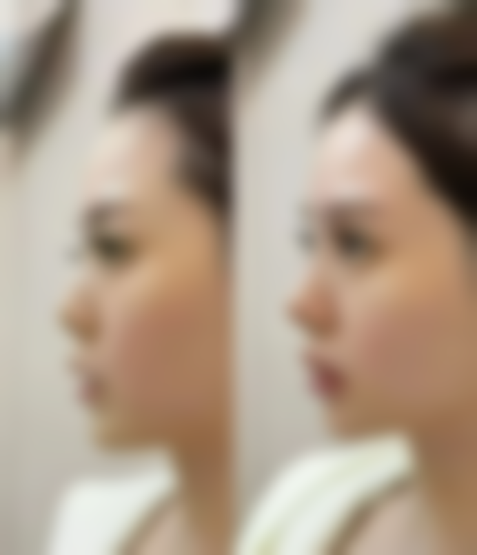 瘦脸针多久见成效图片