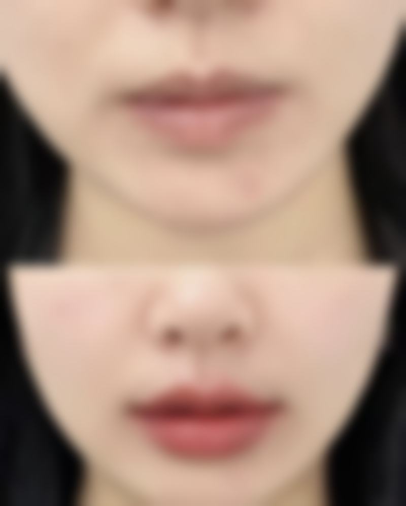 整容下巴修复期多久