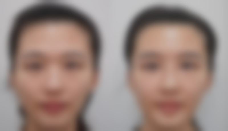 厚嘴唇变薄的方法