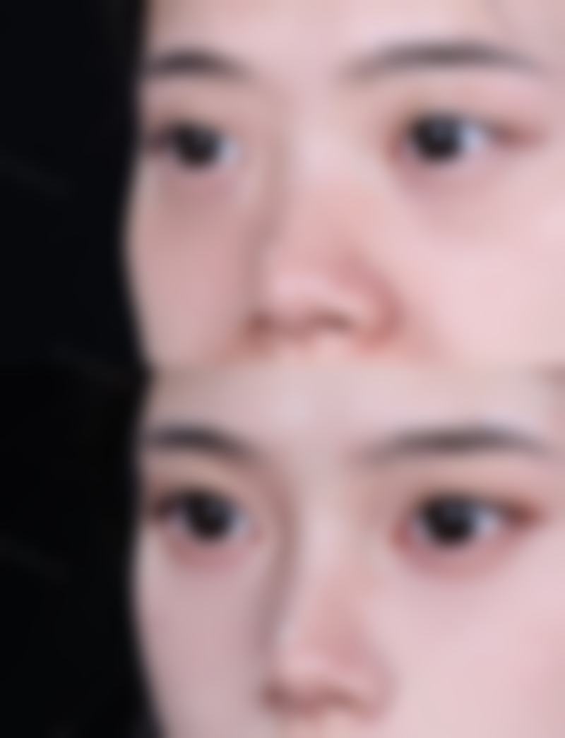 五、瘦脸针可以打疫苗吗