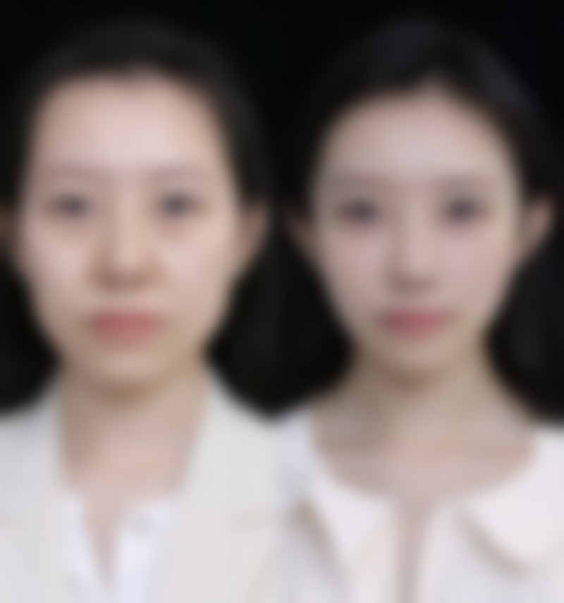 三、可以打瘦脸针吗？有没有副作用