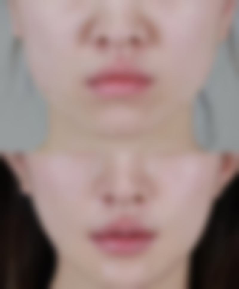 打瘦脸针需要注意什么