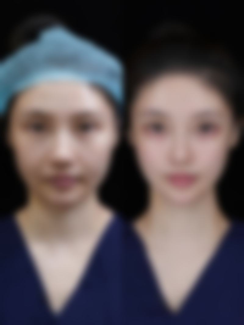 瘦脸针多久打一次成效至佳