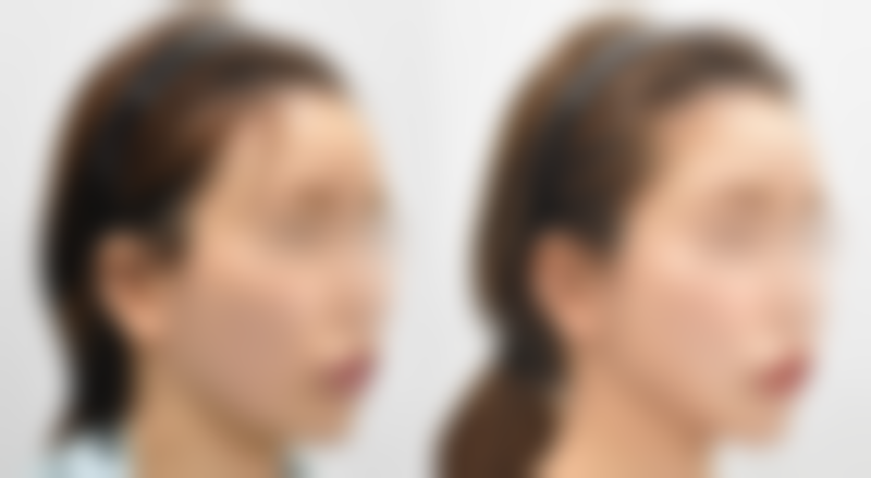 选择合适的除皱方式