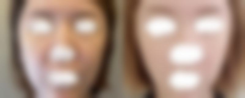 瘦脸针打完多久见效