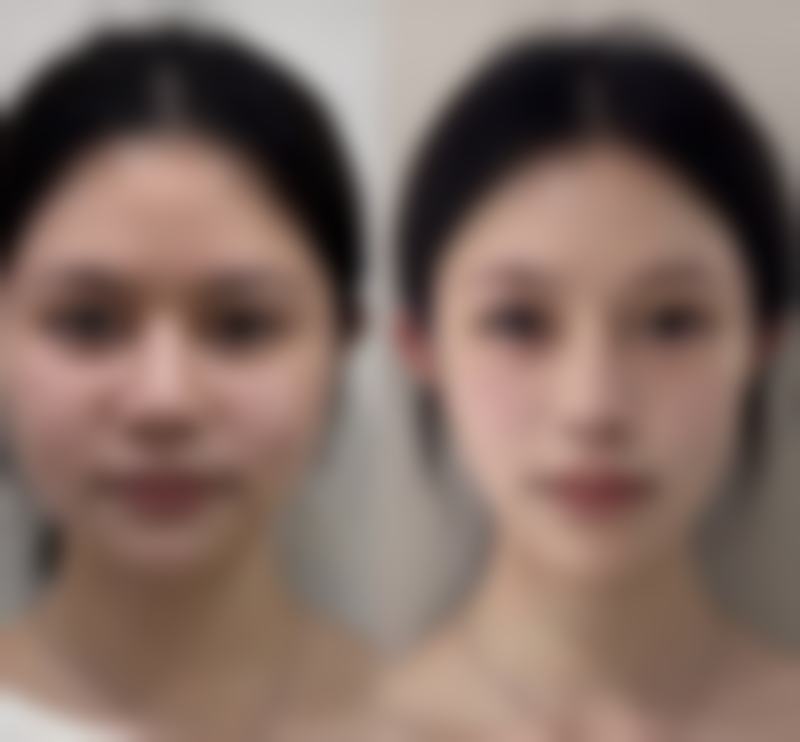 打了瘦脸针不可以吃什么食物