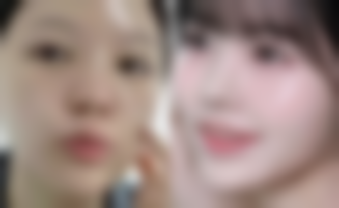 打瘦脸针算是整容吗？揭秘医美界这一争议话题，4大理由告诉你它为何是值得尝试的“微整神器” 