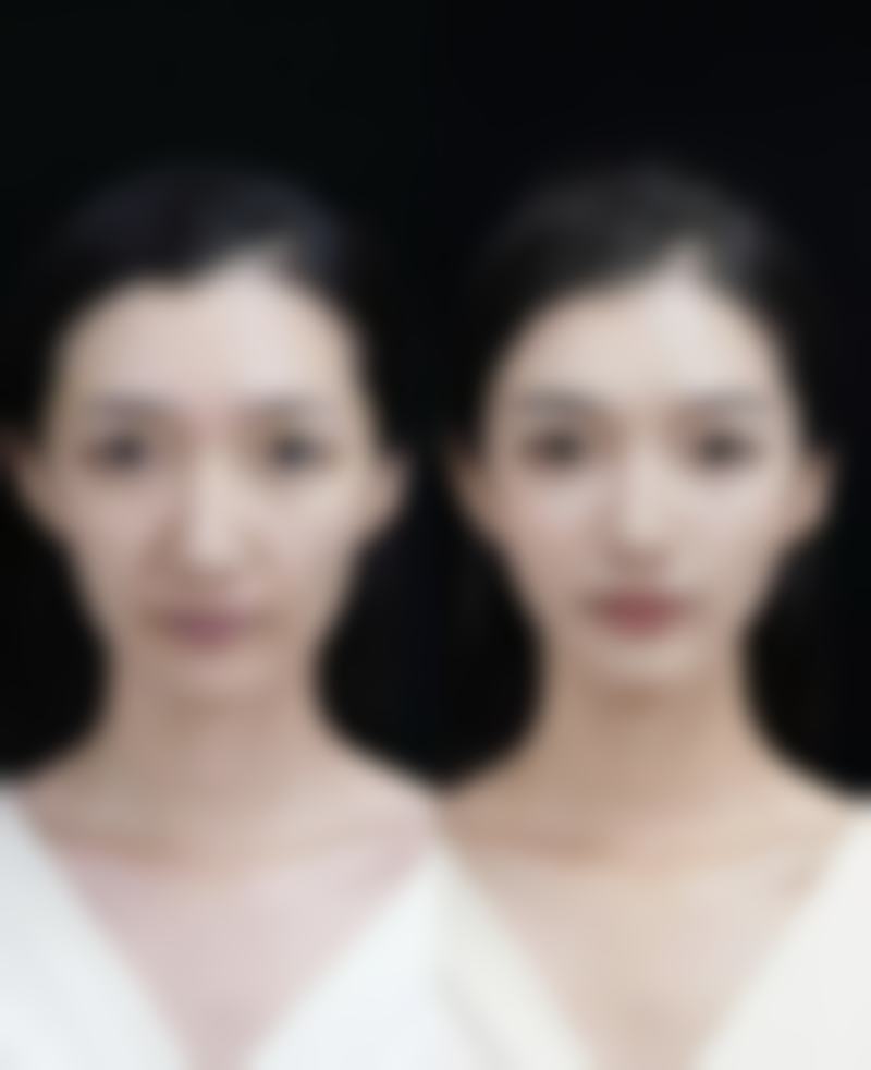 不同除皱方法的价格及适用人群